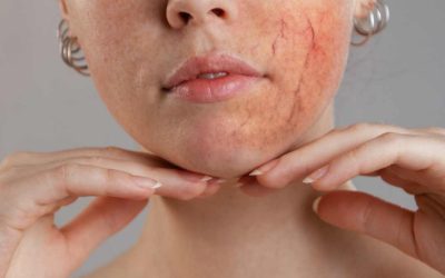 Ocular Rosacea