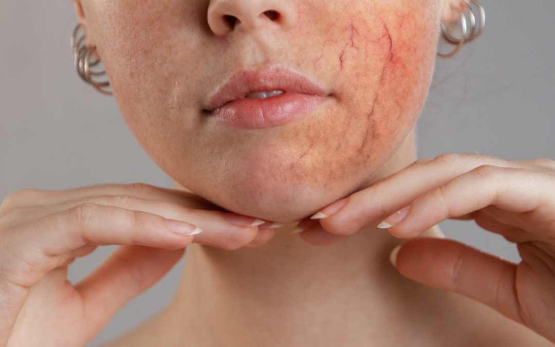 Ocular Rosacea
