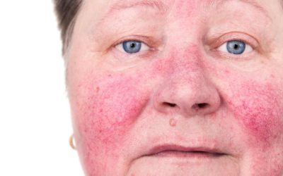 Managing Rosacea